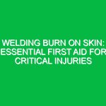 Welding Burn on Skin: Essential First Aid for Critical Injuries