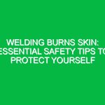 Welding Burns Skin: Essential Safety Tips to Protect Yourself